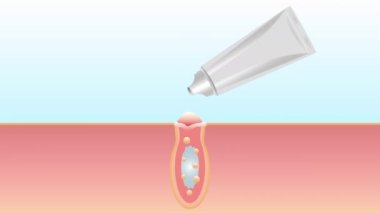 Sivilceleri, temizleme gözenekleri, cilt tedavisi, jel, merhem, tıbbi ürün, metal tüpten alınan krem.... 