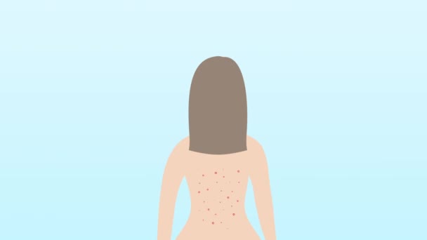 Akné na ženských zádech. Alergická léčba, koncepce kožních problémů. Kavkazský světlé vlasy žena na modrém pozadí v plochém designu. — Stock video