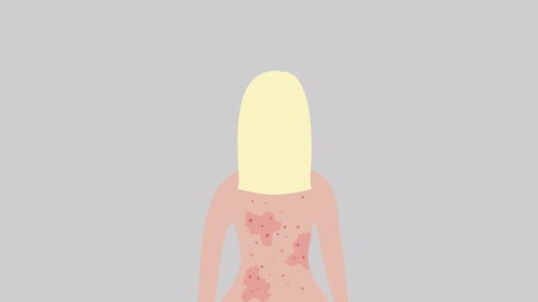 Acné sur le dos des femmes. Traitement des allergies, concept de problèmes de peau. — Video