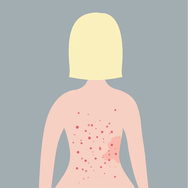 Caucasian short blonde hair woman with acne on her back. Skin problems concept. — Stock Vector