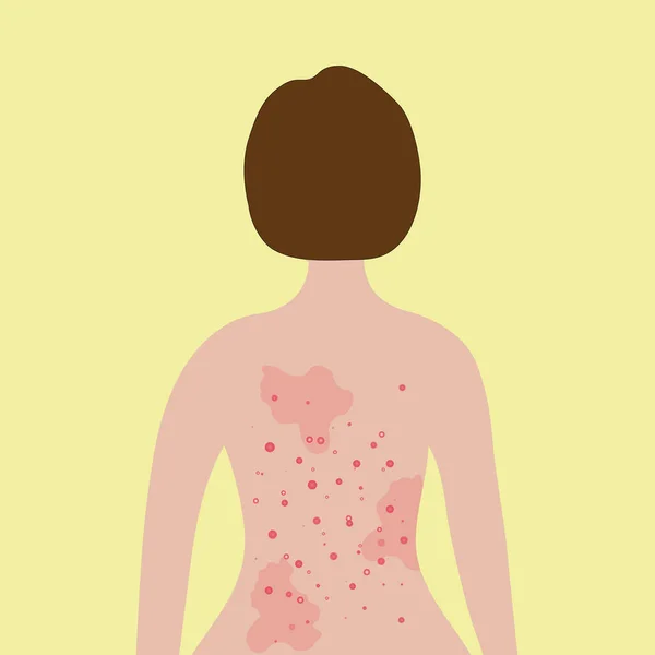 Acne on female back. Allergy treatment, skin problems concept. — Vector de stock