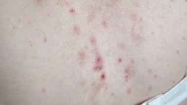 Akne sequelae, yırtık sivilceler, sırtında kaşıntı, dermatolojik sorun. 4k kamera görüntüsü.