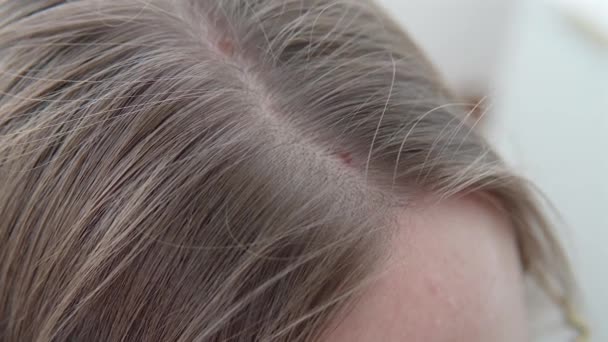 脂漏性皮膚炎 女性の頭の上に長期にわたる深刻な皮膚疾患 皮膚医学の問題をクローズアップ — ストック動画