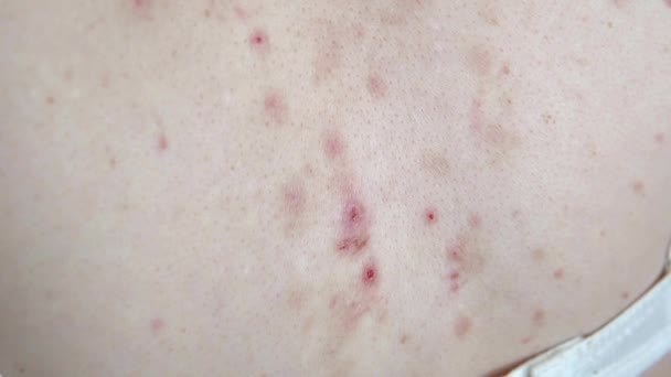 Akné Následky Potrhané Pupínky Svědění Kůže Zádech Dermatologický Problém Záběry — Stock video