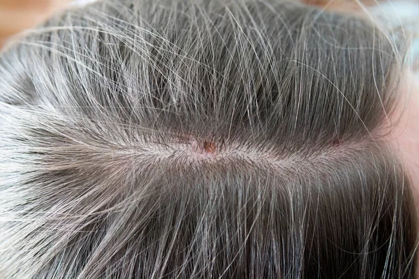 脂漏性皮膚炎 女性の頭の上に長期にわたる深刻な皮膚疾患 皮膚医学の問題をクローズアップ — ストック写真