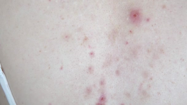 Sequelas Acne Espinhas Rasgadas Comichão Pele Nas Costas Problema Dermatológico — Vídeo de Stock