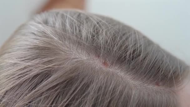 脂漏性皮膚炎のクローズアップ 皮膚疾患 女性の頭の皮膚医学の問題4K映像 — ストック動画