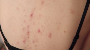 Sivilceli, benekli kadınlar, dermatolojik problemler, cilt bakımı konsepti. 4k çözünürlüğü .