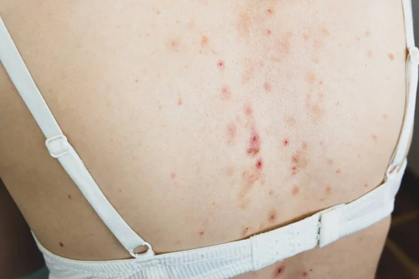 Seitenansicht Von Akne Folgeerkrankungen Gerissene Pickel Hautjucken Rücken Dermatologisches Problem — Stockfoto