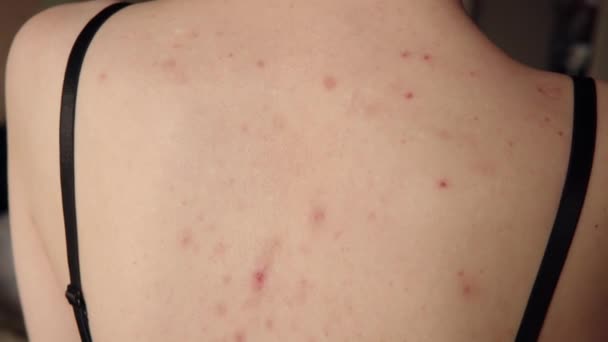 Close Van Acne Sequelae Gescheurde Puistjes Jeuk Van Huid Rug — Stockvideo