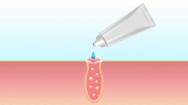 Sivilceleri yok etme süreci, temizleme gözenekleri, cilt tedavisi, jel, merhem, tıbbi ürün, metal tüpten alınan krem. Dermatolojik ve öğretici küre. 