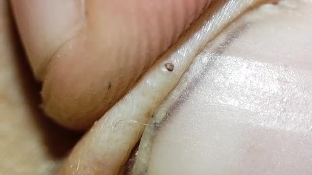 Macro Video Clean Skin Blackhead Remove Black Pimple Fingers — 图库视频影像