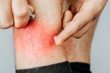 Bacağındaki alerjik döküntüler için tedavi amaçlı merhem. Sedef, kozmetik ve dermatolojik sorunların merhemle tedavi edilmesi.