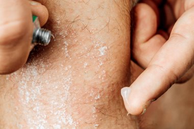 Bacağındaki alerjik döküntüler için tedavi amaçlı merhem. Sedef, kozmetik ve dermatolojik sorunların merhemle tedavi edilmesi.