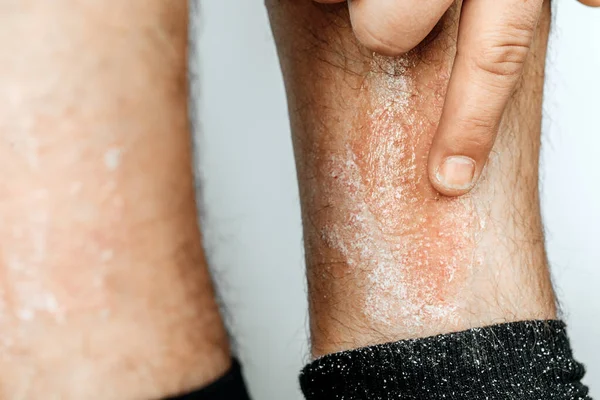 Psoriasis Aguda Una Enfermedad Dermatológica Incurable Autoinmune Piel Una Gran — Foto de Stock