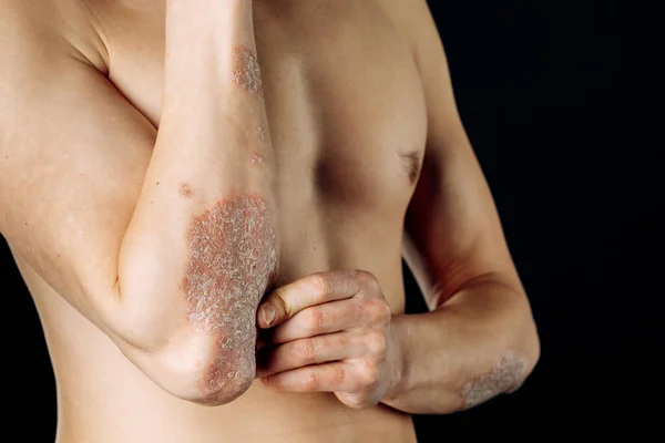 Akutní Psoriáza Loktech Autoimunitně Nevyléčitelné Dermatologické Kožní Onemocnění Velká Červená — Stock fotografie