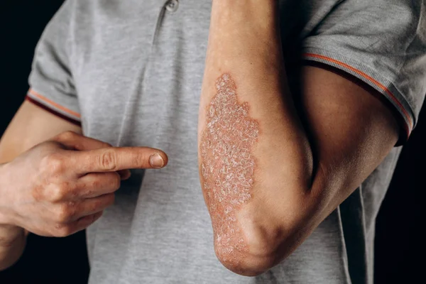 Dirseklerdeki akut sedef hastalığı otoimmün, tedavisi olmayan dermatolojik bir hastalıktır. Dirseklerinde büyük kırmızı, iltihaplı, pullu bir kızarıklık. Sedef hastalığından etkilenmiş eklemler..