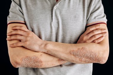 Dirseklerdeki akut sedef hastalığı otoimmün, tedavisi olmayan dermatolojik bir hastalıktır. Dirseklerinde büyük kırmızı, iltihaplı, pullu bir kızarıklık. Sedef hastalığından etkilenmiş eklemler..