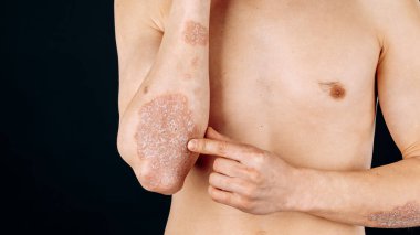 Dirseklerdeki akut sedef hastalığı otoimmün, tedavisi olmayan dermatolojik bir hastalıktır. Dirseklerinde büyük kırmızı, iltihaplı, pullu bir kızarıklık. Sedef hastalığından etkilenmiş eklemler..