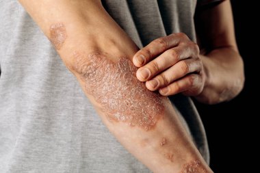 Dirseklerdeki akut sedef hastalığı otoimmün, tedavisi olmayan dermatolojik bir hastalıktır. Dirseklerinde büyük kırmızı, iltihaplı, pullu bir kızarıklık. Sedef hastalığından etkilenmiş eklemler..