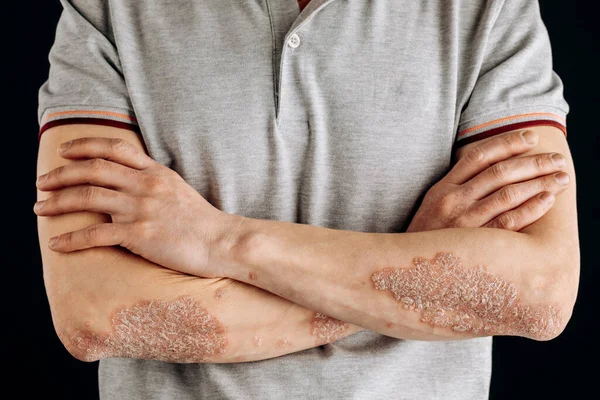 手肘上的急性银屑病是一种自身免疫力无法治愈的皮肤病 肘部红肿的 发炎的 片状的大皮疹受银屑病关节炎影响的关节 — 图库照片