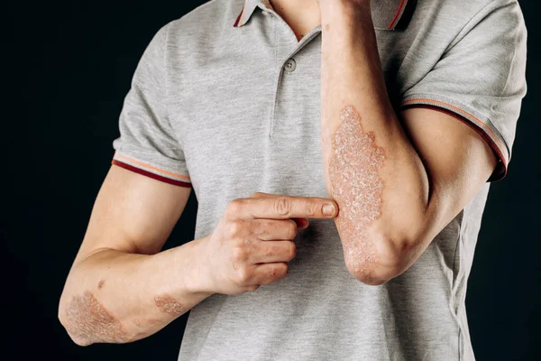 Psoriasis Aguda Los Codos Una Enfermedad Dermatológica Incurable Autoinmune Piel — Foto de Stock