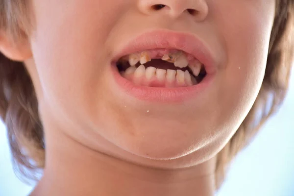 bad teeth in a child and caries,