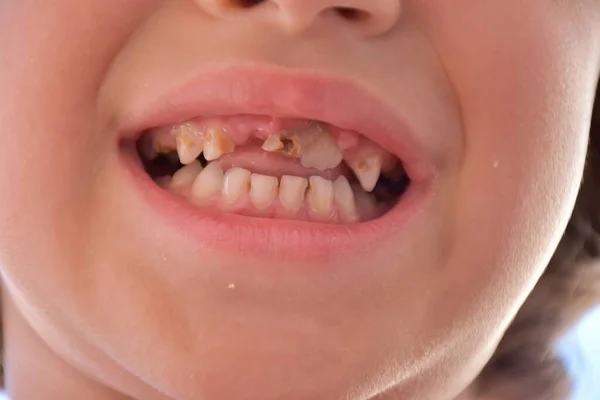 Dåliga Tänder Ett Barn Och Karies — Stockfoto