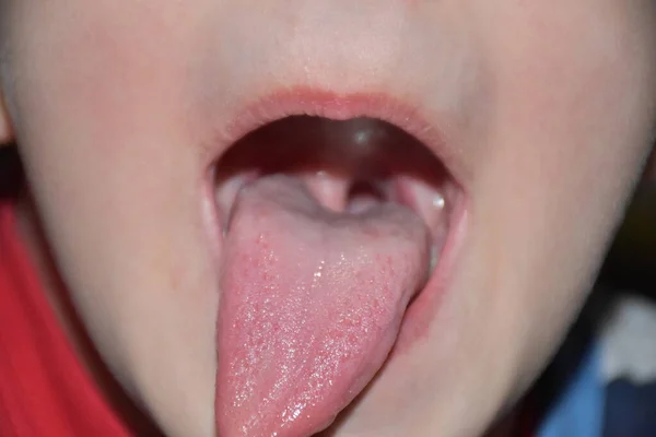 Χαλασμένα Δόντια Ένα Παιδί Και Τερηδόνα — Φωτογραφία Αρχείου