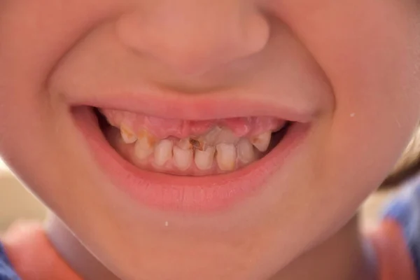 Chore Zęby Dziecka Próchnica — Zdjęcie stockowe