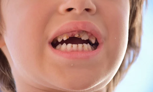 子供の悪い歯と世話をし — ストック写真