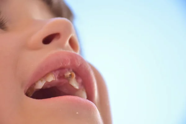 Dientes Podridos Niño Caries — Foto de Stock