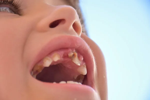 子供の悪い歯と世話をし — ストック写真