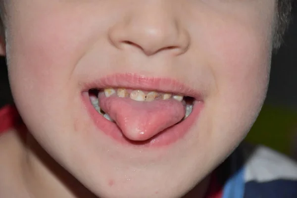 Bad Teeth Child Caries — Stock Photo, Image