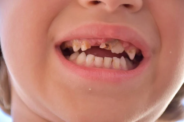 Slechte Tanden Een Kind Cariës — Stockfoto