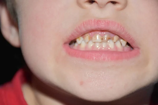 아이들의 치아에 생기는 악취와 — 스톡 사진