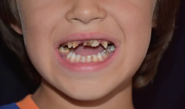 Slechte Tanden Een Kind Cariës — Stockfoto