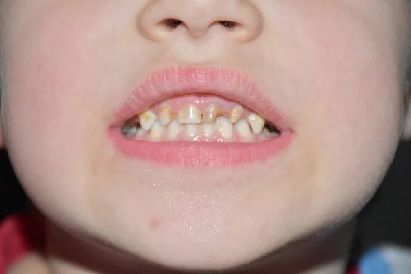 Плохие Зубы Ребенка Пещеры — стоковое фото