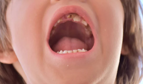 아이들의 치아에 생기는 악취와 — 스톡 사진