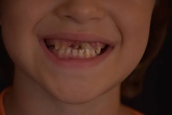 Dientes Podridos Niño Caries — Foto de Stock