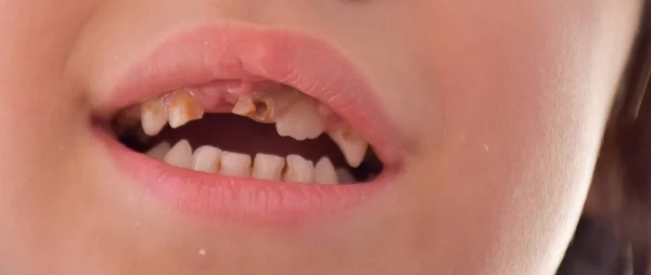 Špatné Zuby Dítěti Caries — Stock fotografie