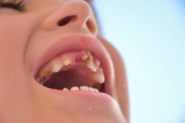 Dientes Podridos Niño Caries —  Fotos de Stock