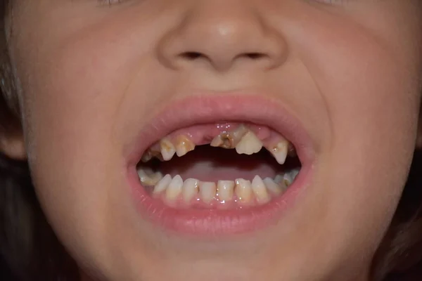 Mauvaises Dents Chez Enfant Caries — Photo