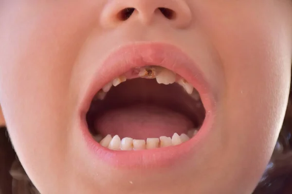 小孩的坏牙齿和蛀牙 — 图库照片