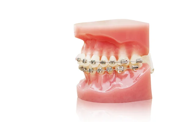 Braces model — Stock Photo, Image