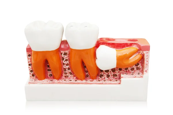 Crescimento imperfeito dos dentes — Fotografia de Stock