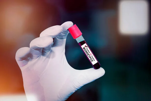 医生手戴手套 在实验室内携带猴痘病毒阳性血样 进行近距离检查 — 图库照片