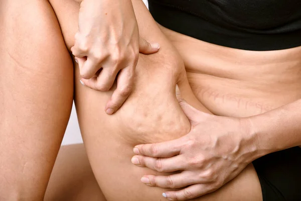 Cellulite Markierungsproblem Bein Dicke Frau Mit Übermäßigem Bauchkneifen Oberschenkel Übergewichts — Stockfoto