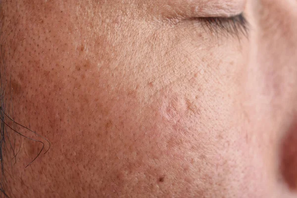 Hautproblem Mit Falten Und Pigmentierung Close Männer Gesicht Mit Akne — Stockfoto