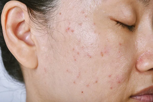 Problema Pele Facial Doença Acne Adultos Close Rosto Mulher Com — Fotografia de Stock